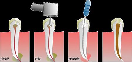 无锡滨湖区康贝佳牙齿做根管治疗要多少钱